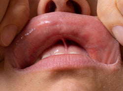 Fordyce Spots (White Bumps) On Lips: Symptoms, Causes, Treatments & Risk Factors