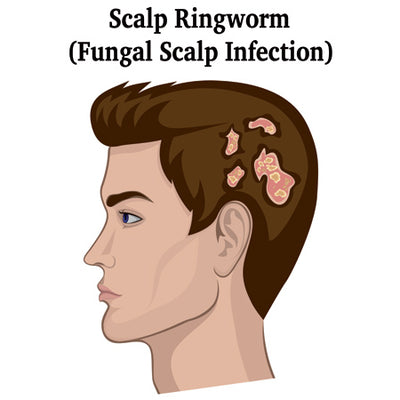 Fungal Scalp Infection (Or Tinea Capitis) - How To Identify & Treat It?