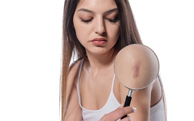 Get Rid Of Old Scars Easily With These Useful Tips