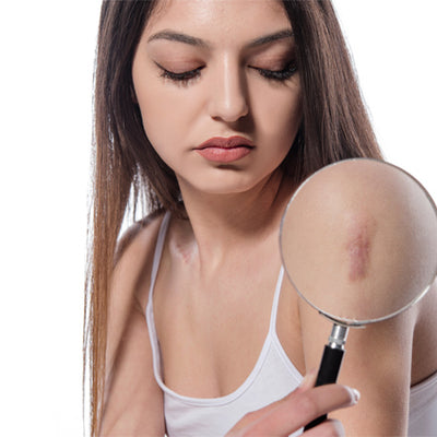 Get Rid Of Old Scars Easily With These Useful Tips