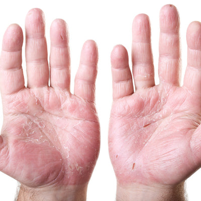 Hand Dermatitis: Causes, Prevention & Treatments