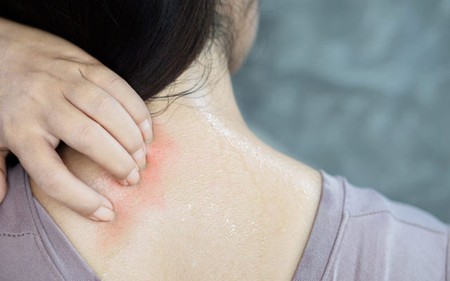 mild heat rash on neck