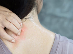 Heat Rash: How To Treat And Prevent It This Summer