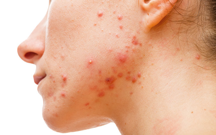 Hormonal Acne - Causes, Symptoms, Treatments – SkinKraft