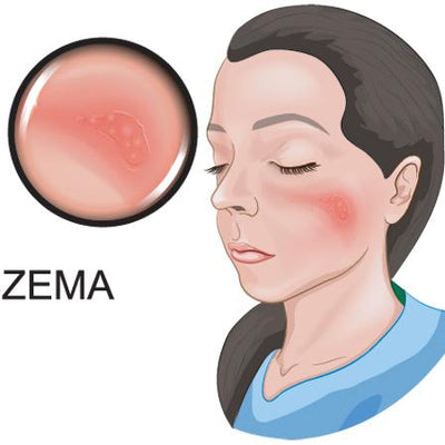 How To Treat Eczema – Causes, Symptoms, Prevention & 5 Different Types