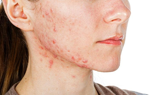 How To Identify And Treat Nodular Acne?