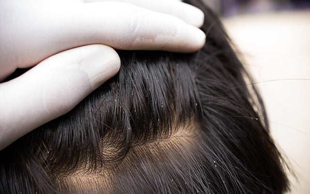 बालों से जुएं हटाने के 10 घरेलू नुस्खे : 10 Home Remedies For Removing Head Lice