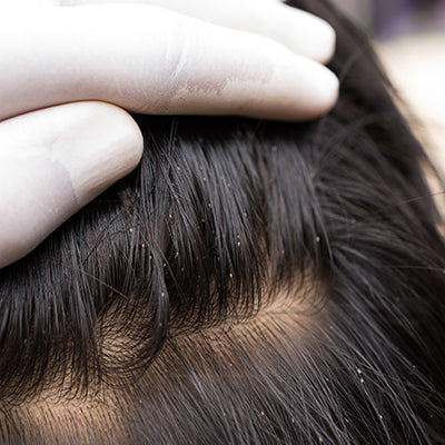 बालों से जुएं हटाने के 10 घरेलू नुस्खे : 10 Home Remedies For Removing Head Lice
