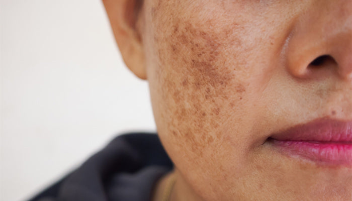 can glutathione reduce melasma Topical Treatments for Melasma: A Systematic Review of Randomized Controlled Trials - JDDonline How Do I Get Rid