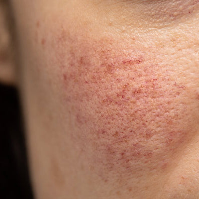 How To Treat Rosacea - Causes, Symptoms, Types