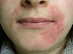 Perioral Dermatitis: Cure, Signs, Risks & Everything You Need To Know