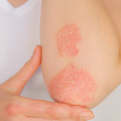 Is Psoriasis A Serious Skin Condition? Can It Be Treated?