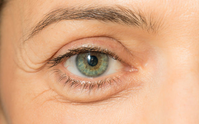 Puffy Eyes: Triggers, Treatments & Foods To Eat/Avoid