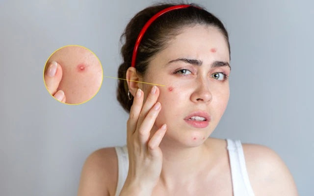 Exploding Pustules How To Treat Pustules On Face? – SkinKraft