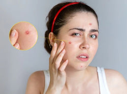 How To Treat Pustules On Face?