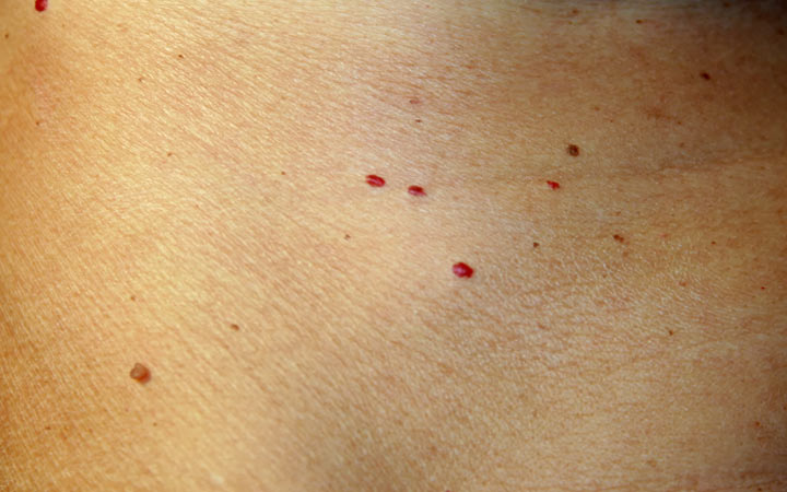 Dark Red Spots On Arm
