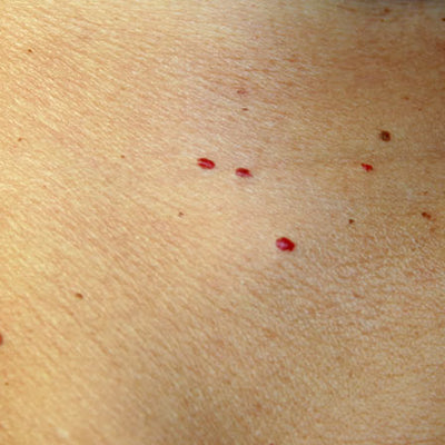 What Causes Red Spots On Skin & How To Treat Them