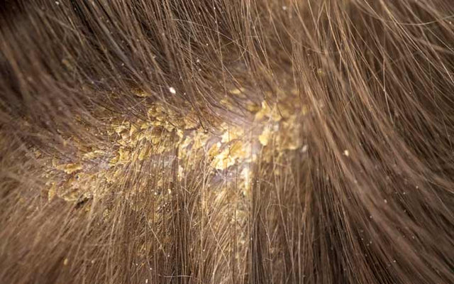 Scabs and Sores on Scalp: Pictures, Causes, Treatment