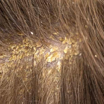 11 Causes of Scalp Scabs + How To Treat Them?