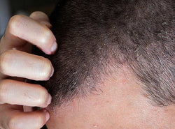 Scalp Eczema - Signs, Causes, Prevention And Treatments