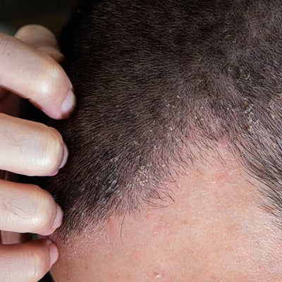 Scalp Eczema - Signs, Causes, Prevention And Treatments