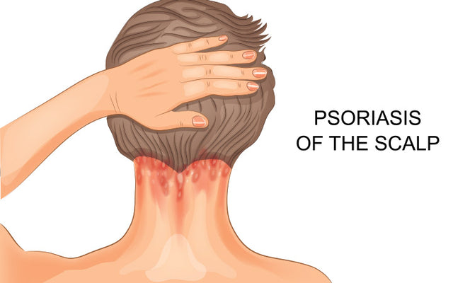 Scalp Psoriasis: Oral & Topical Treatments, Home Remedies & Quick Tips