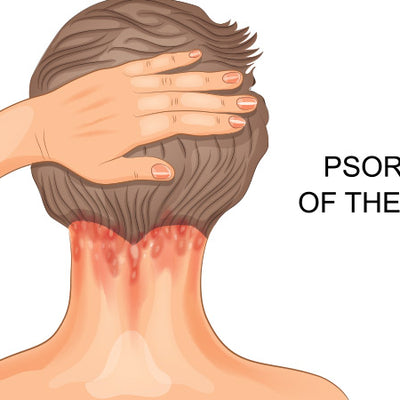 Scalp Psoriasis: Oral & Topical Treatments, Home Remedies & Quick Tips