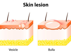 Skin Lesions: Symptoms, Causes And Treatment