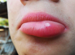 Swollen Lips: Causes, Home Remedies, Medical Treatments & Precautions