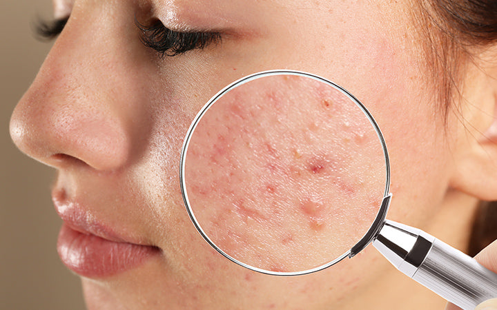 11 Habits That Make Acne Worse – SkinKraft