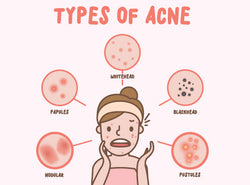 What Are The Different Types of Acne and How To Treat Them