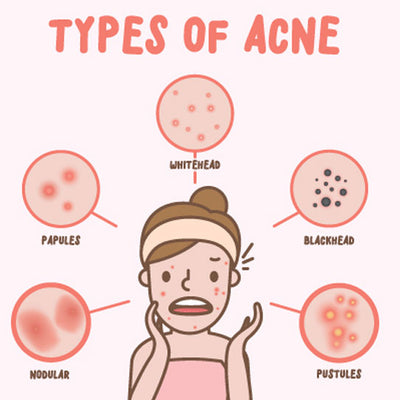 What Are The Different Types of Acne and How To Treat Them