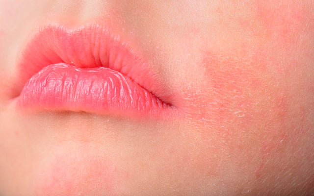 How Can You Prevent Rashes On Your Lips?