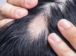 Balding: Causes, Symptoms And Treatments
