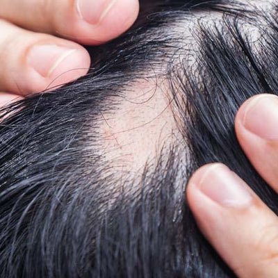 Balding: Causes, Symptoms And Treatments