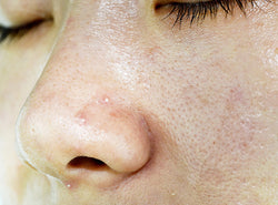 Oily Skin - Causes, Prevention, Treatments