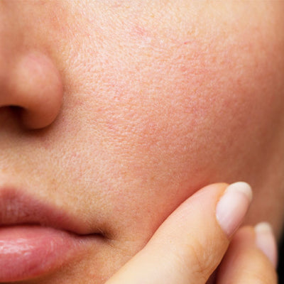 How To Close Open Pores on Face - Types, Causes, Treatment Methods