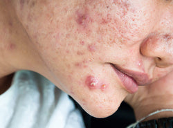 What Is Cystic Acne And How Do You Treat It?