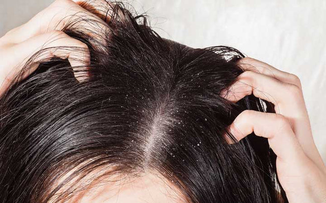 Truth Anti-dandruff Hair Oils - Dos & Dont's – SkinKraft