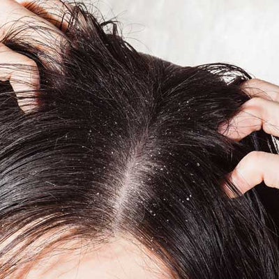 The Truth About Anti-dandruff Hair Oils - Dos & Dont's