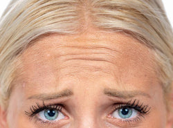 What Are Frown Lines - All You Should Know About Frown Lines
