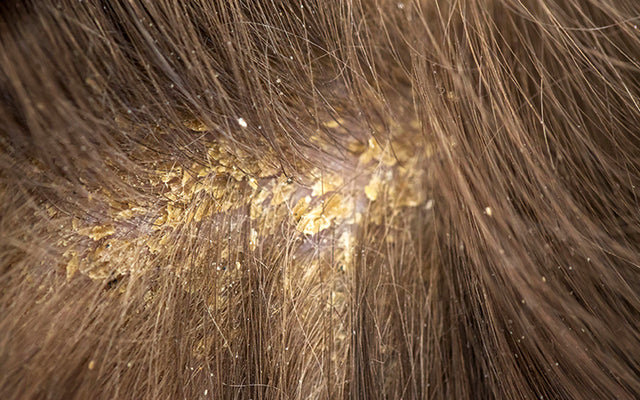 Sebum Build-Up On Scalp + How To Deal With It? – SkinKraft