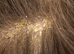Sebum Build-Up On Scalp + How To Deal With It?