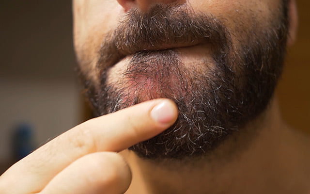 beard dandruff shampoo