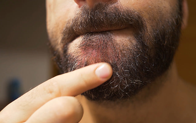 Beard Dandruff: Causes, Home remedies & Treatments