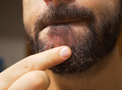 Beard Dandruff: Causes, Home remedies & Treatments
