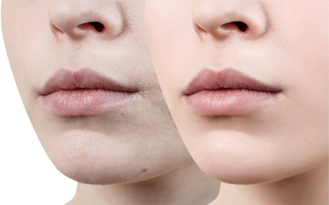 Patchy Dry Skin around Mouth Area: Effective Tips to Heal Fast