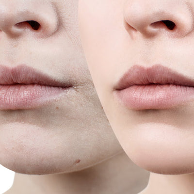 How Can You Treat Dry Skin Around Your Mouth?