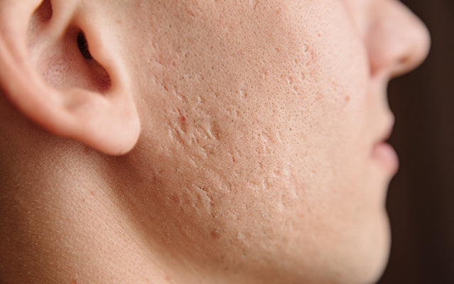 how to get rid of boxcar acne scars