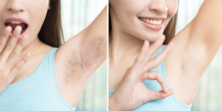 Laser Hair Removal Vs. Electrolysis: Which One Is Better For Your ...